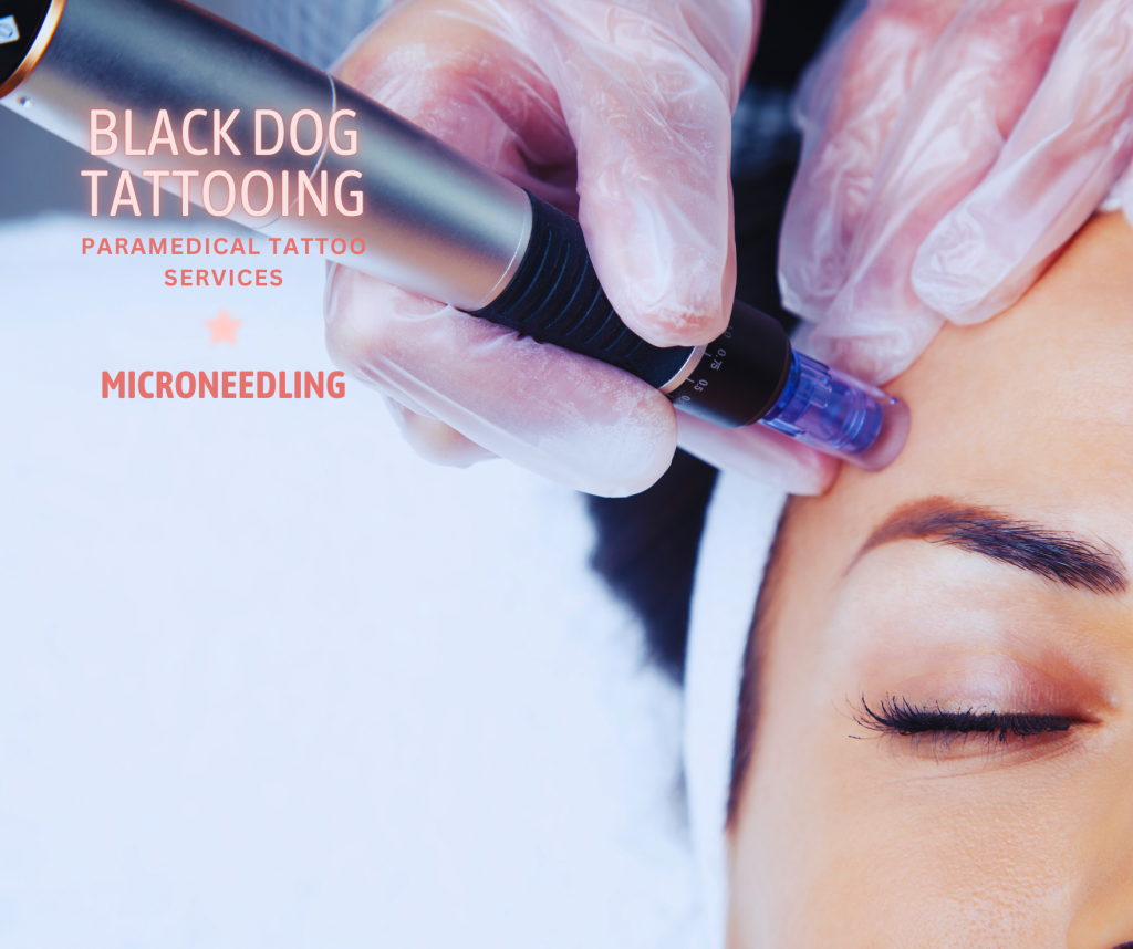 Microneedling